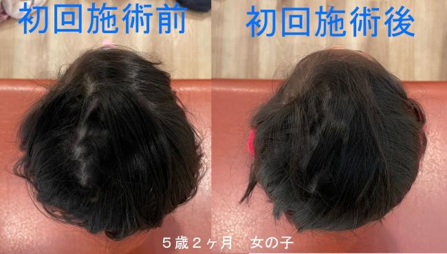 斜頭症・絶壁 赤ちゃんの頭の形 - 墨田区の両国さいち整骨院