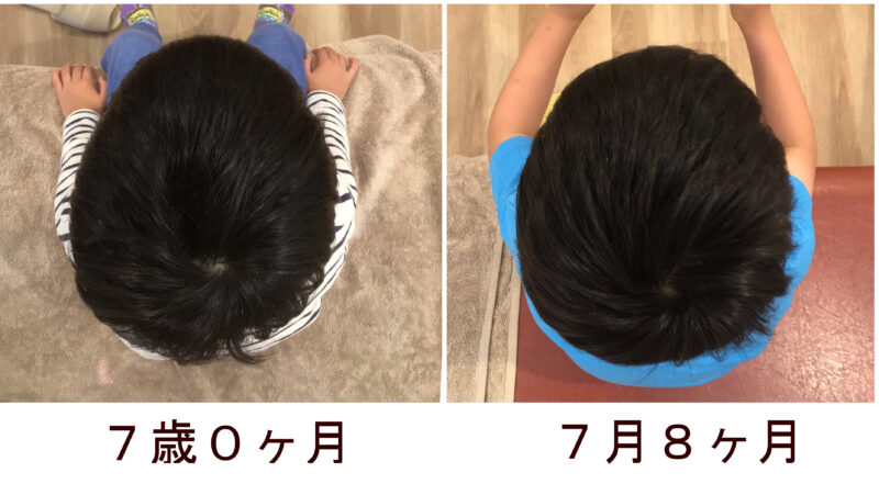７歳斜頭症の施術経過