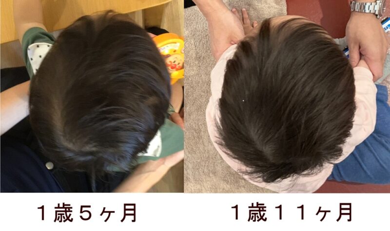 斜頭症施術経過1歳5ヶ月